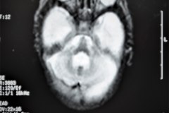 hidrocefalia-rnm-2004-013
