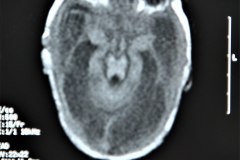 hidrocefalia-rnm-2004-026