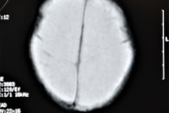 hidrocefalia-rnm-2004-027