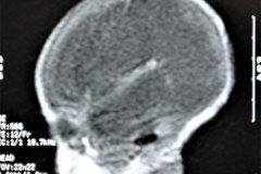 hidrocefalia-rnm-2004-028