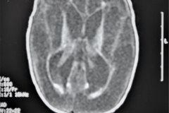 hidrocefalia-rnm-2004-029
