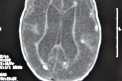 hidrocefalia-rnm-2004-030