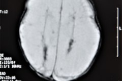 hidrocefalia-rnm-2004-031