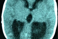 hidrocefalia-tac-derivacion-ventriculo-peritoneal-1997-000