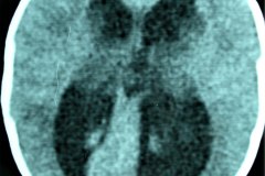 hidrocefalia-tac-derivacion-ventriculo-peritoneal-1997-001