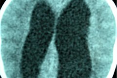 hidrocefalia-tac-derivacion-ventriculo-peritoneal-1997-002