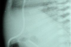 hidrocefalia-tac-derivacion-ventriculo-peritoneal-1997-003