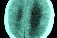 hidrocefalia-tac-derivacion-ventriculo-peritoneal-1997-004