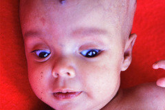 hidrocefalia-valvula-derivacion-vp-hemangioma-1986_08_25-h-grace-kelly-paez-chapeton-002