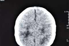 hidrocefalia-y-mielomeningocele-tac-1996-003