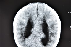 hidrocefalia-y-mielomeningocele-tac-1996-005