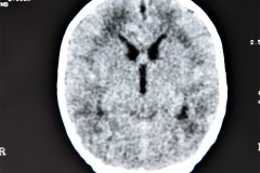 hidrocefalia-y-mielomeningocele-tac-1996-008