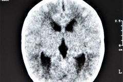 hidrocefalia-y-mielomeningocele-tac-1996-009