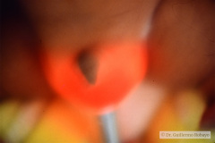 hidrocele-bil-transiluminacion-000