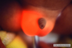 hidrocele-bil-transiluminacion-004