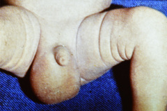 hidrocele-der-transiluminacion-000