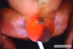 hidrocele-der-transiluminacion-001