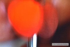 hidrocele-transiluminacion-001