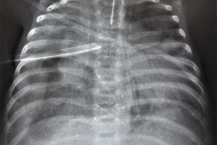 hidroneumotorax-al-paso-cateter-yugular-der-iatrogenia-1996-000