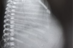 hidrops-anasarca-hidropesia-edema-generalizado-fetal-no-inmune-neumotorax-a-tension-clapso-pulmonar-1992-003