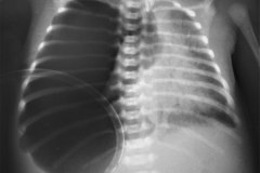 hidrops-anasarca-hidropesia-edema-generalizado-fetal-no-inmune-neumotorax-a-tension-clapso-pulmonar-1992-004