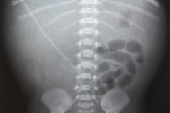 hidrops-anasarca-hidropesia-edema-generalizado-fetal-no-inmune-neumotorax-a-tension-clapso-pulmonar-1992-010