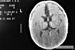 higroma-frontal-bil-cerebral-1987-001