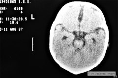 higroma-frontal-bil-cerebral-1987-002