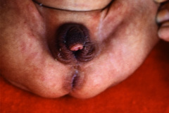 hiperplasia-suprarrenal-congenita-000