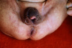 hiperplasia-suprarrenal-congenita-001