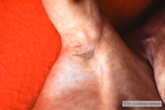 hiperplasia-suprarrenal-congenita-003