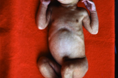 hiperplasia-suprarrenal-congenita-007