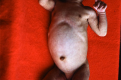 hiperplasia-suprarrenal-congenita-008