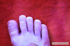 hipertension-endocraneana-exoftalmus-005