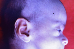 hipertension-endocraneana-exoftalmus-006