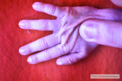 hipertension-endocraneana-exoftalmus-008