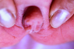 hipertrofia-clitoris-001