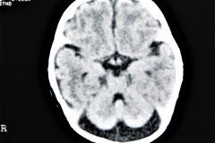 hipoplasia-cerebelosa-down-1996-003