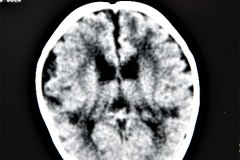 hipoplasia-cerebelosa-down-1996-004