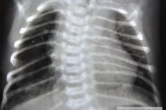 hipoplasia-costal-izq-000