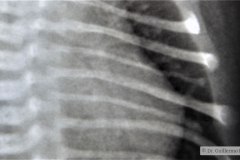 hipoplasia-costal-izq-001