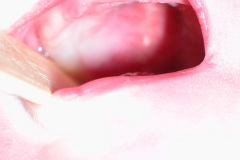 hipoplasia-cuerpo-calloso-colpocefalia-calcificacion-gangliobasal-2006-002