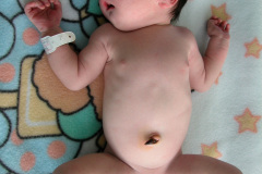 hipoplasia-cuerpo-calloso-colpocefalia-calcificacion-gangliobasal-2006-003
