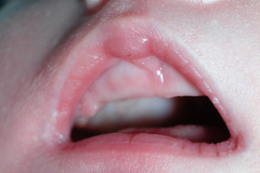 hipoplasia-cuerpo-calloso-colpocefalia-calcificacion-gangliobasal-2006-005