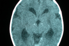 hipoplasia-cuerpo-calloso-colpocefalia-calcificacion-gangliobasal-2006-011