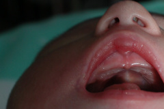 hipoplasia-cuerpo-calloso-colpocefalia-calcificacion-gangliobasal-2006-014