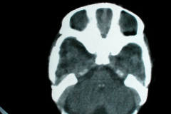 hipoplasia-cuerpo-calloso-colpocefalia-calcificacion-gangliobasal-2006-016