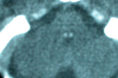 hipoplasia-cuerpo-calloso-colpocefalia-calcificacion-gangliobasal-2006-017