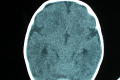 hipoplasia-cuerpo-calloso-colpocefalia-calcificacion-gangliobasal-2006-018