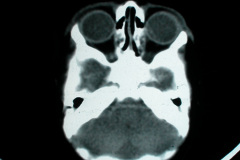 hipoplasia-cuerpo-calloso-colpocefalia-calcificacion-gangliobasal-2006-020